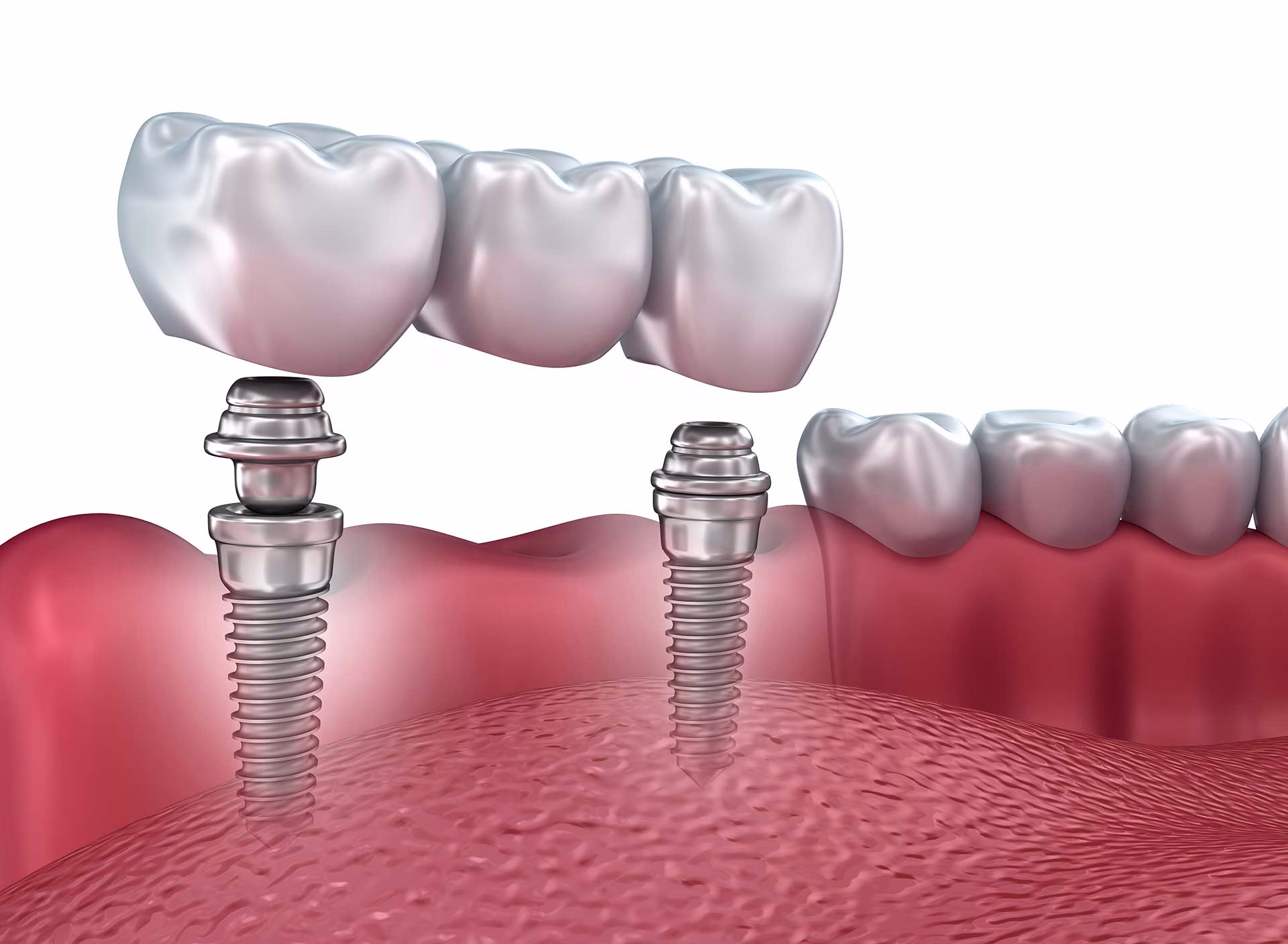 dental implants in Richboro, PA