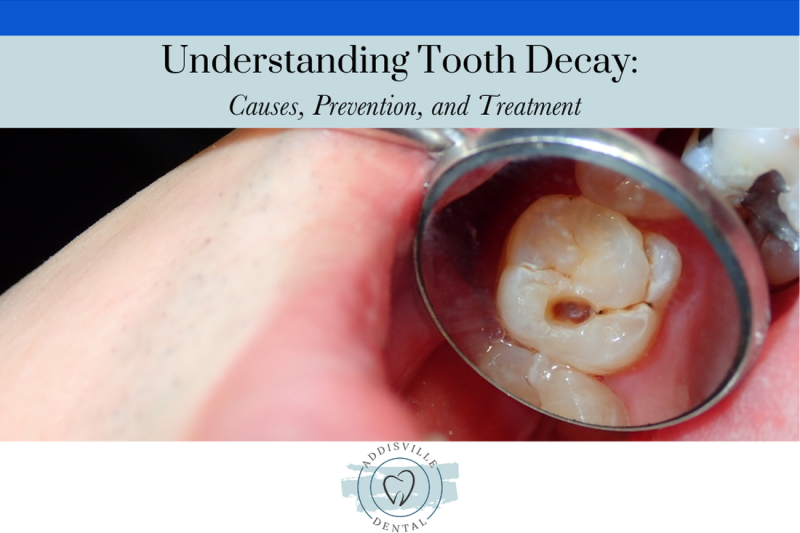 Understanding Tooth Decay Causes, Prevention, and Treatment